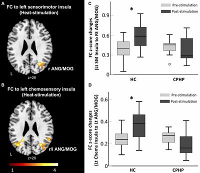 Altered Sensory Insular Connectivity in Chronic Postsurgical Pain Patients